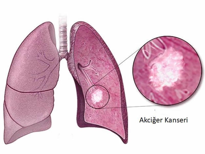 Akciğer Kanseri